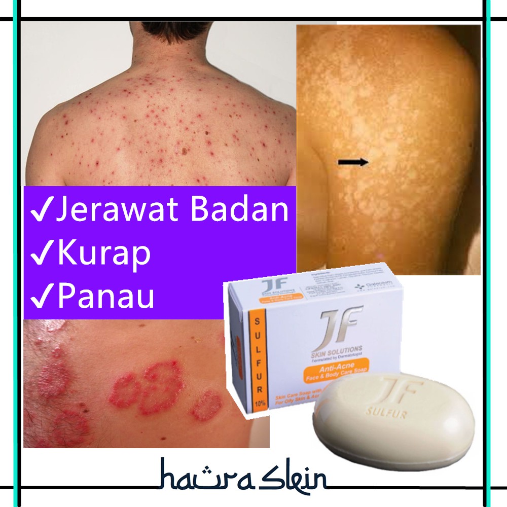 Kurap Panau Acne Soap 100 Skin Doctor Clinics Fungal Mujarab Antiacne Sulfur Soap Fungal Shopee Singapore