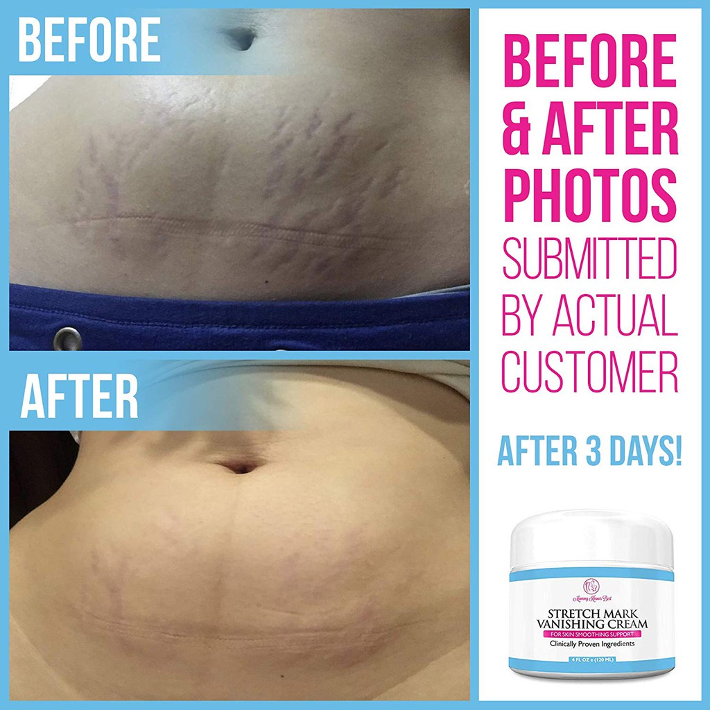 mom and co stretch marks cream