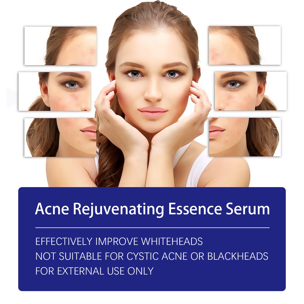 West&Month Acne Treatment Essence Acne Remover Pimple Acne Scar Removal