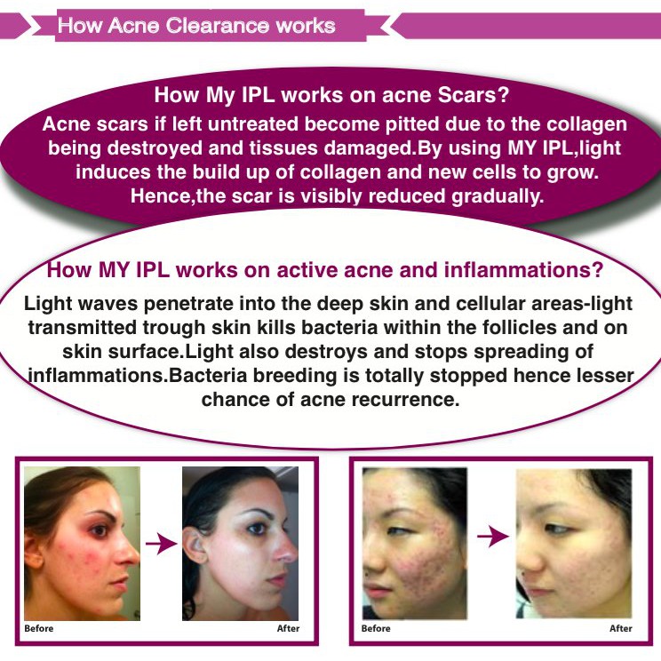 ipl acne