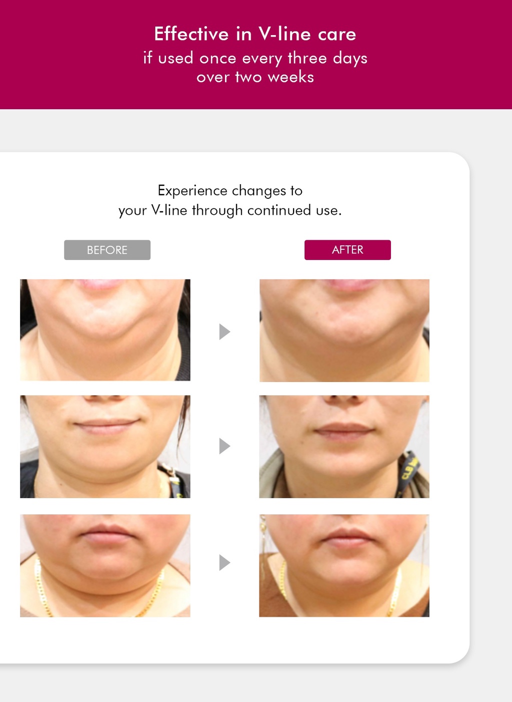 Vela Contour Ultra V Lifting Band Clinically Proven to improve Double