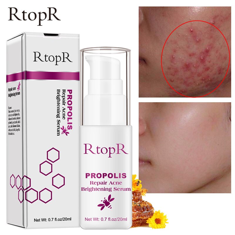 acne scar brightening serum