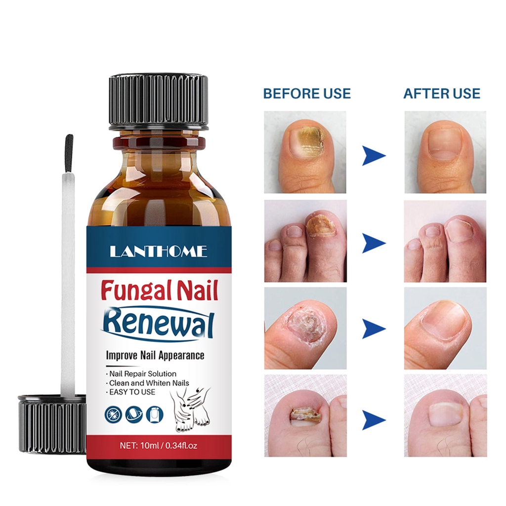 Lanthome Herbal Fungal Nail Renewal Anti Fungal for nail repair and whitening Treatment Shopee