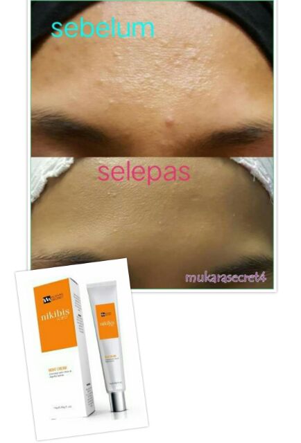 nikibi acne cream