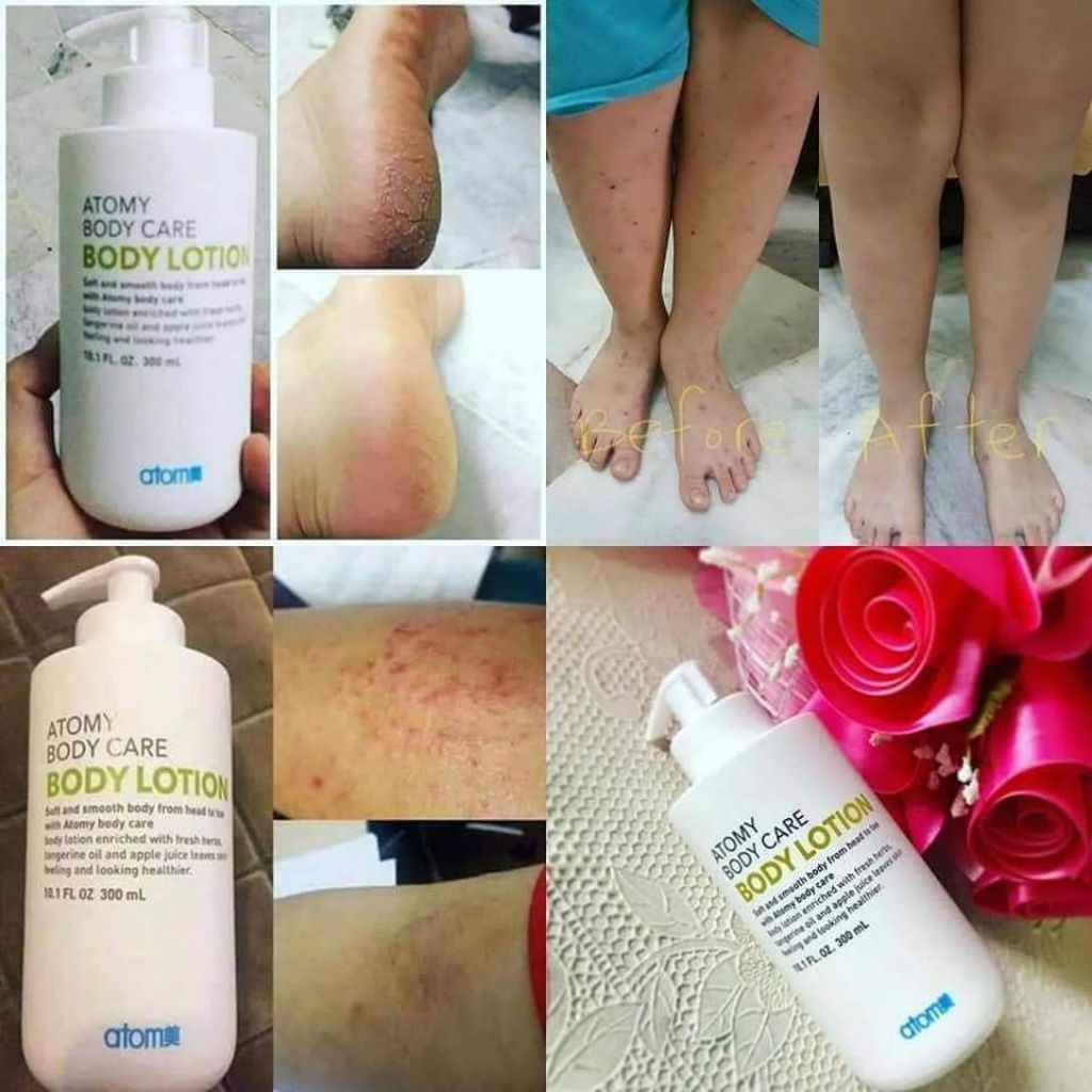 atomy eczema
