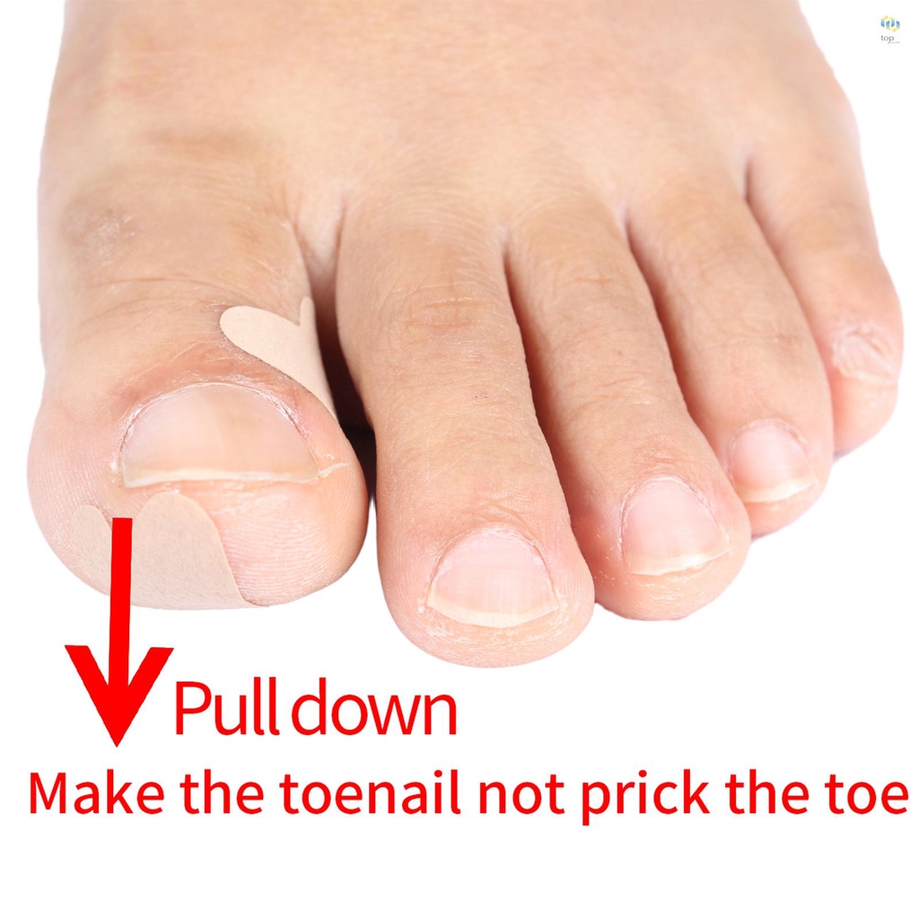 Ingrown Nail Correction Kit Ingrown Toenail Stickers Straightening