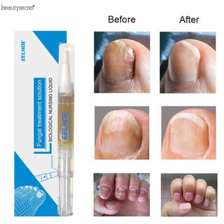 Nail Fungus Treatment Price And Deals Nov 2021 Shopee Singapore