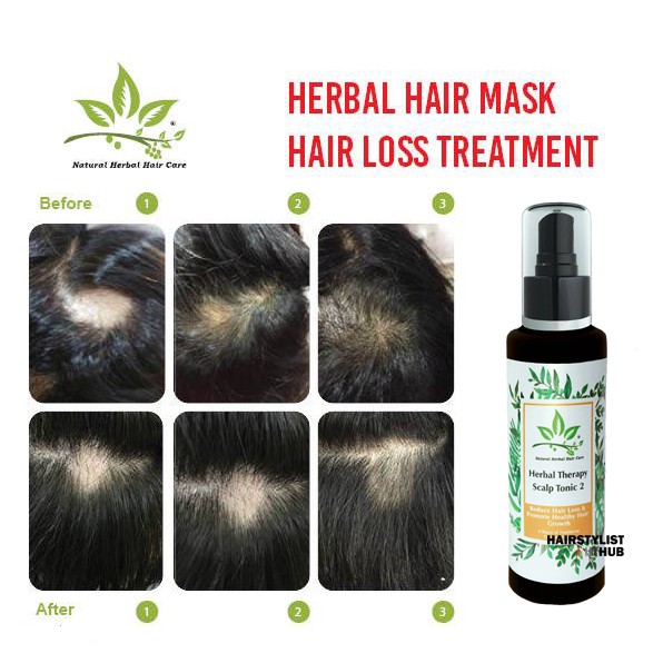 Herbal Hair loss Tonic / Herbal Therapy Scalp Tonic 2 / Hair loss treatment  / Hair Fall Control + Free gift | Shopee Singapore