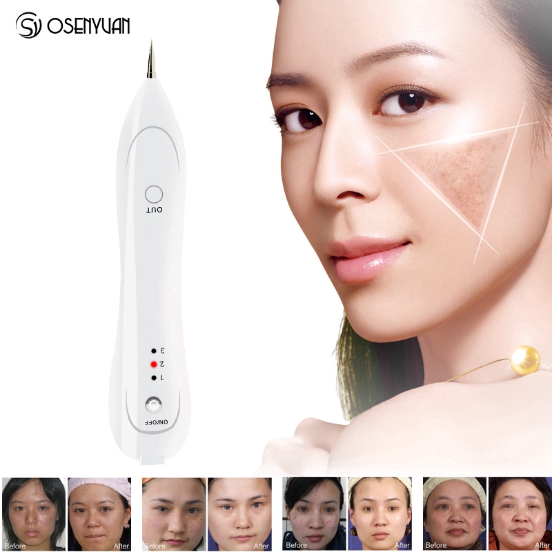 laser freckle removal
