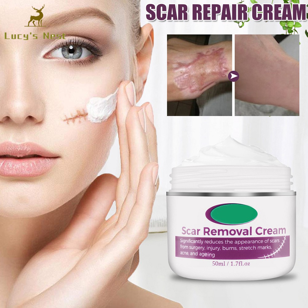 marks cream removal