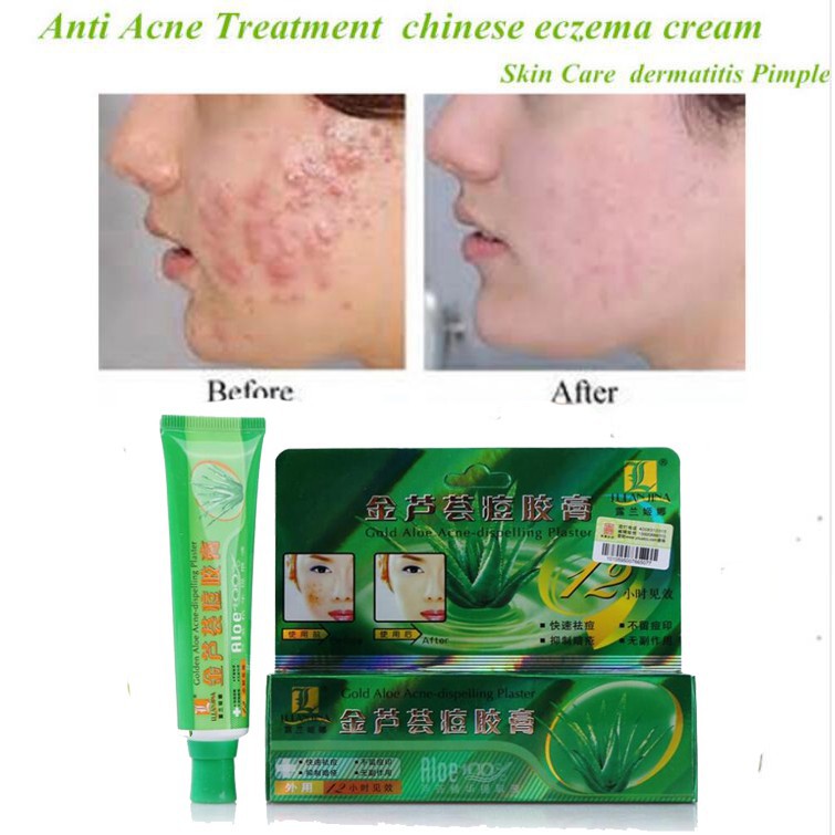best acne treatment for eczema
