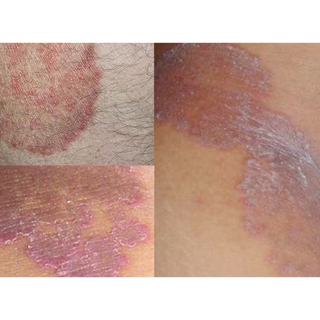 Itching Medicine Kudis Kurap Panau Water Eat Itching Slit Shopee Singapore