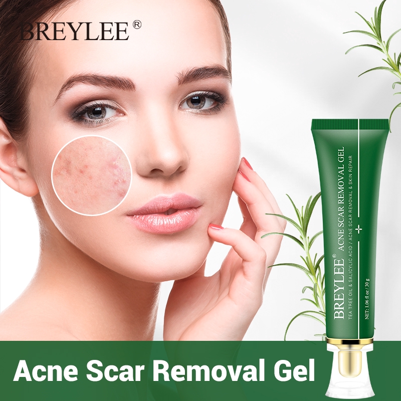 acne marks removal