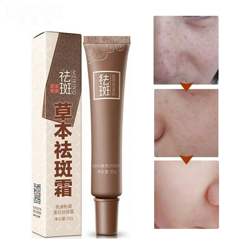 age spot lightening cream