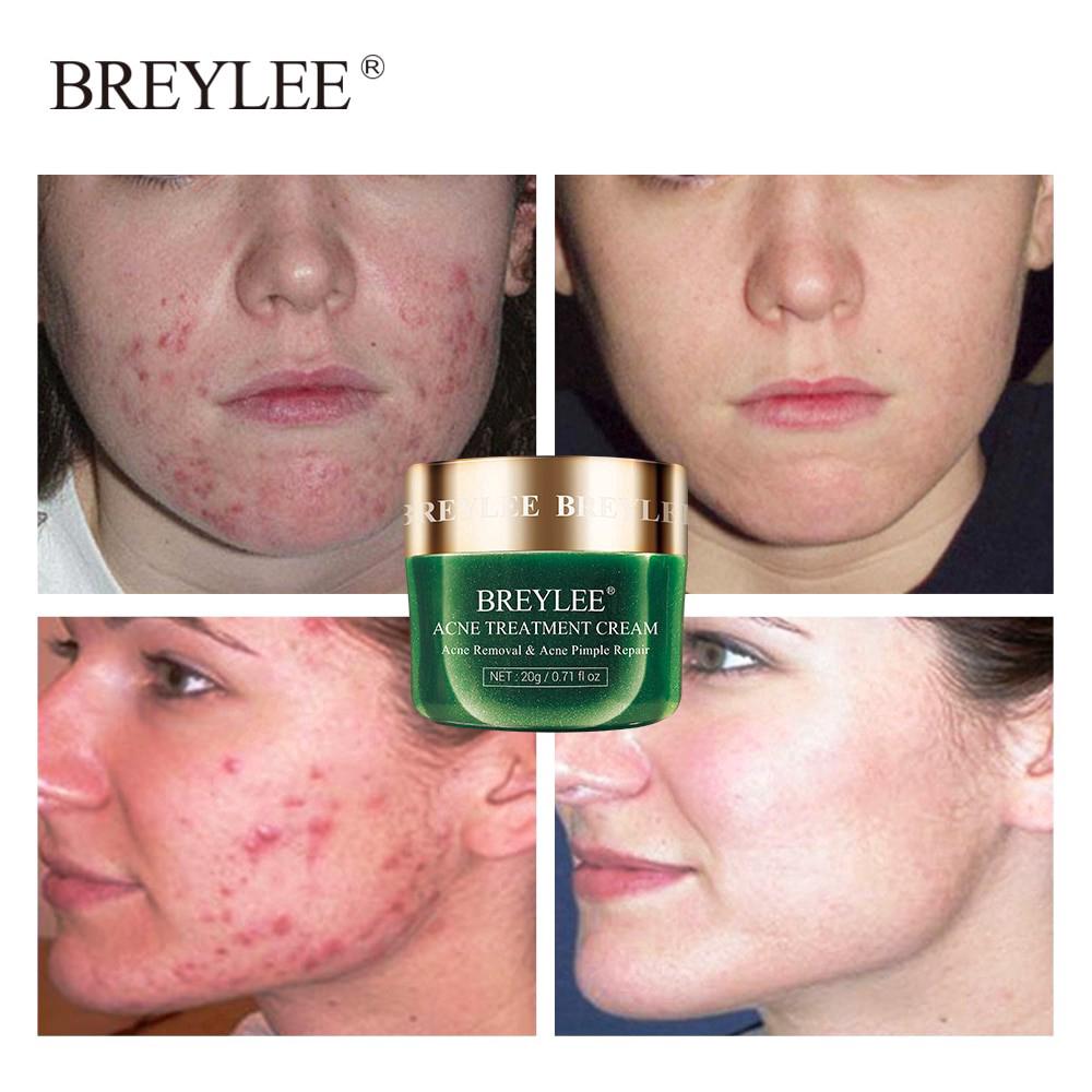 BREYLEE Acne Treatment Cream Anti Acne Face Cream | Shopee Singapore