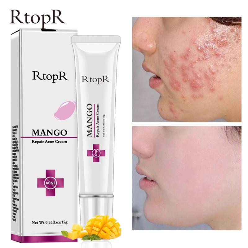 acne repair cream