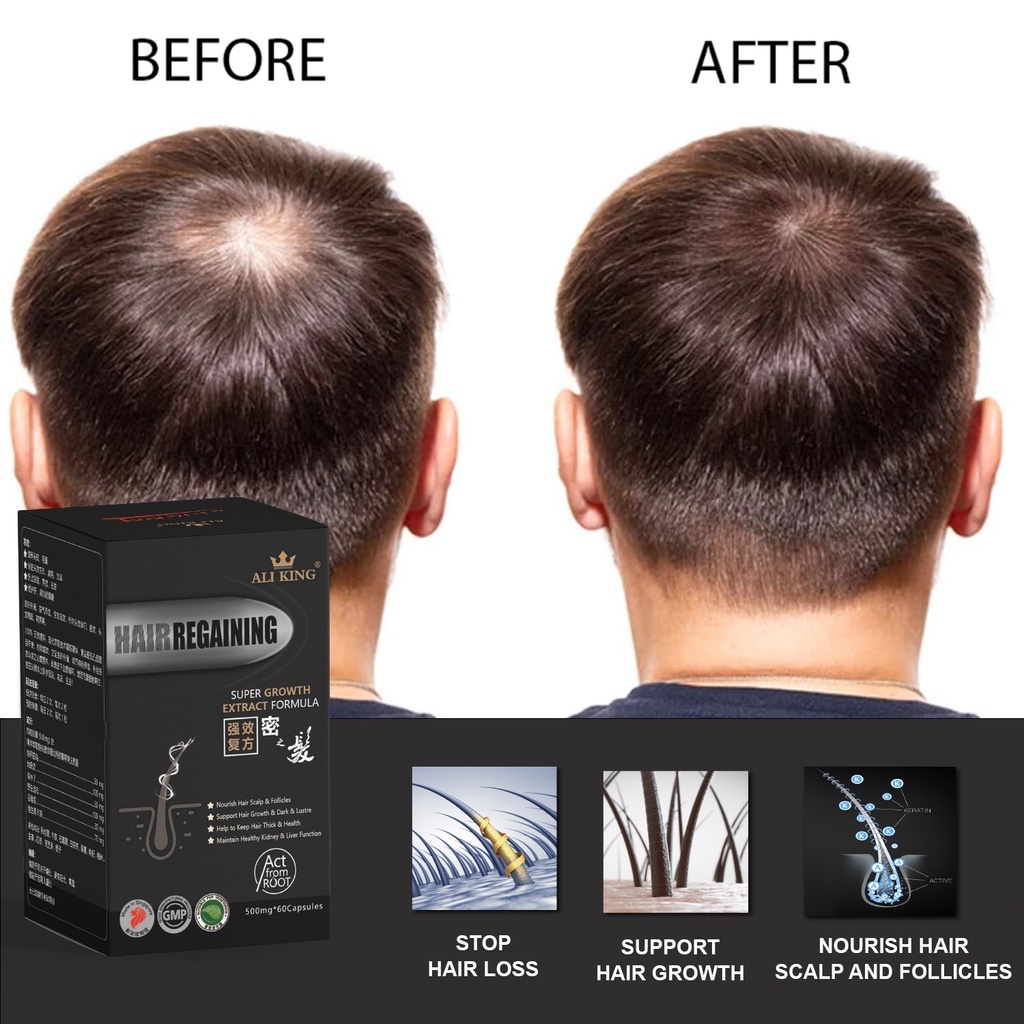 Ali King] Hair Regaining | Super Hair Growth | Stop Hair Loss,Thinning |  Nourish Scalp & Follicles | 60 Veg Caps | Shopee Singapore