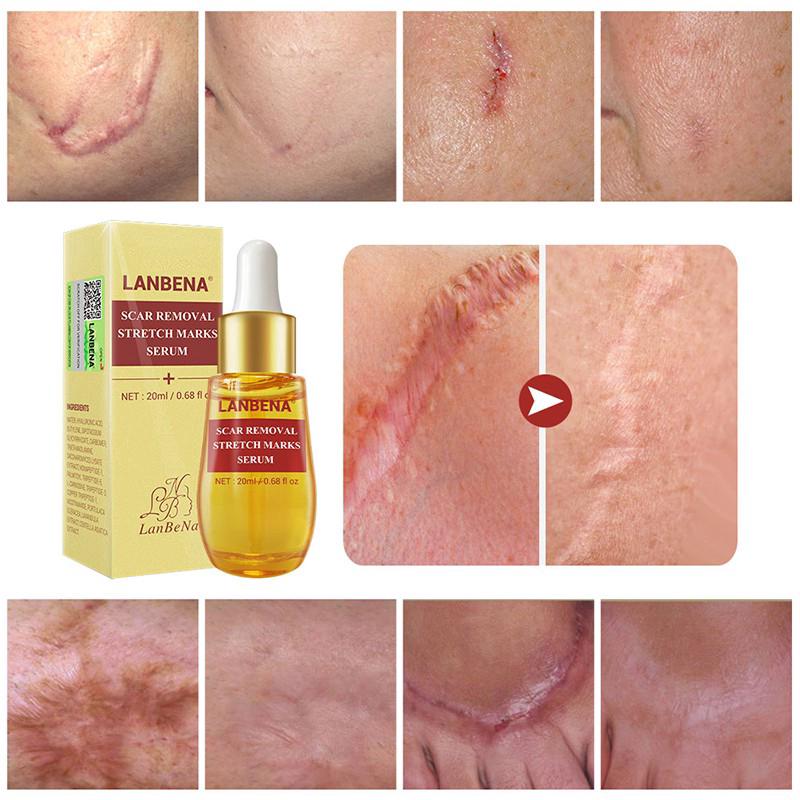 Lanbena Acne Scar Removal Cream Price In Pakistan