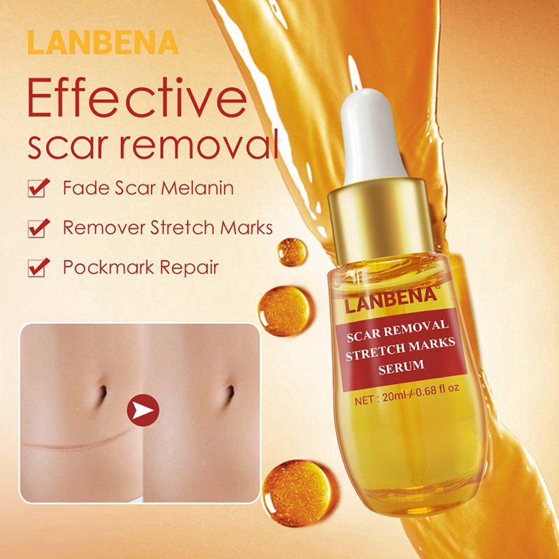 lanbena stretch mark removal