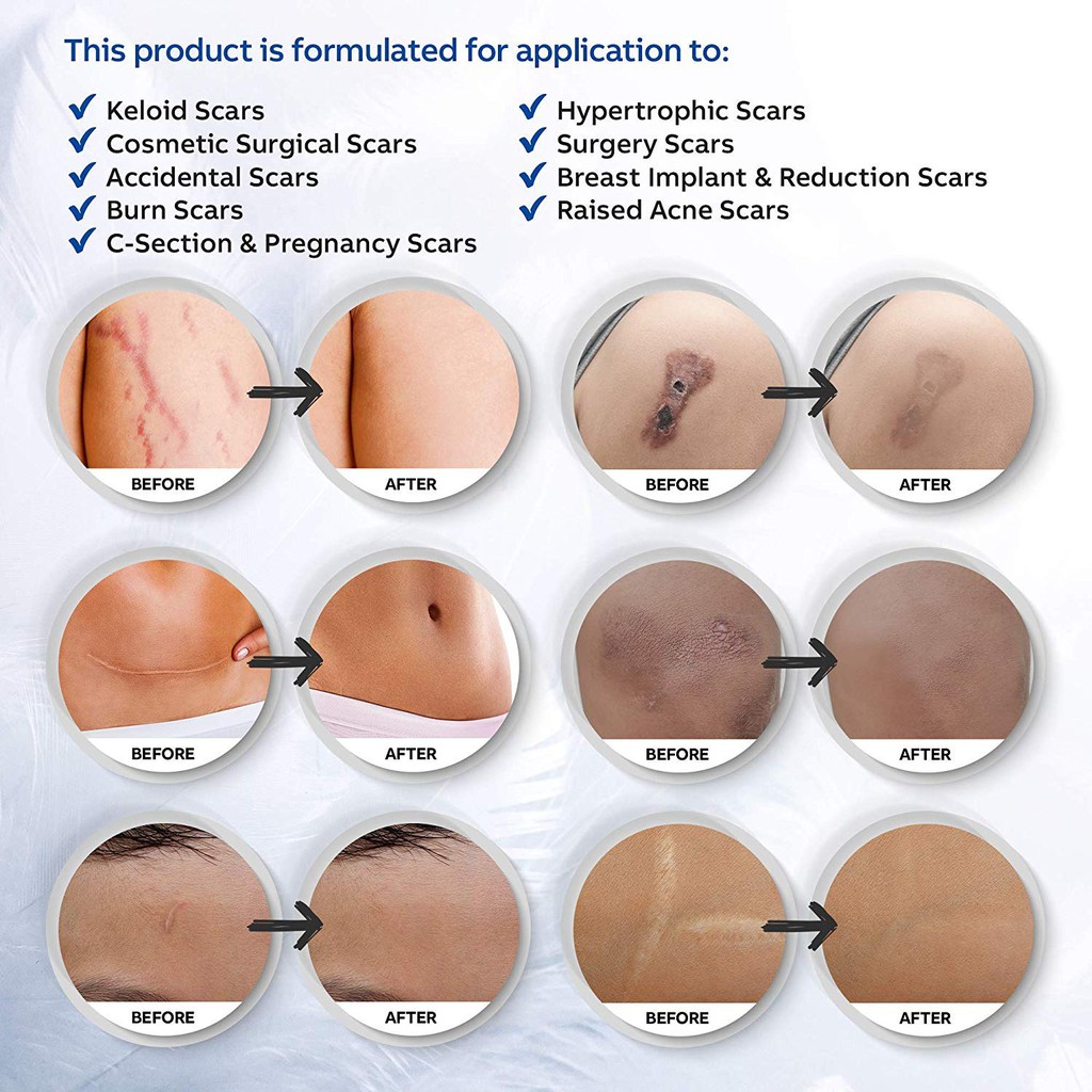 Puriderma Medical Silicone Scar Removal Sheets Fast Effective On Keloid Surgery Burn Acne C Section Scars 5pcs Shopee Singapore