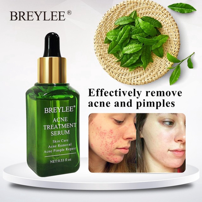 BREYLEE Acne Treatment Serum Anti-Acne Scar Removal Cream Remove Acne