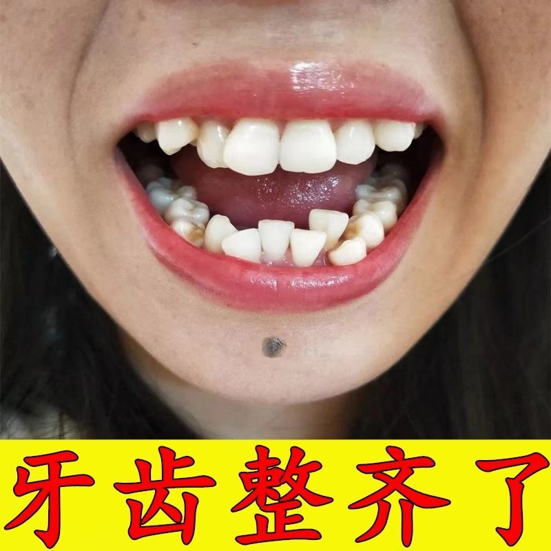 牙套 Orthodontic Appliance Bucktooth Ground Baotian Correction Of Malocclusion Permanent Correction Of Incisor Gap And Anti Molar Braces牙齿 矫正器龅牙地包天矫正牙齿咬合不正门牙缝永久矫正防磨牙牙套