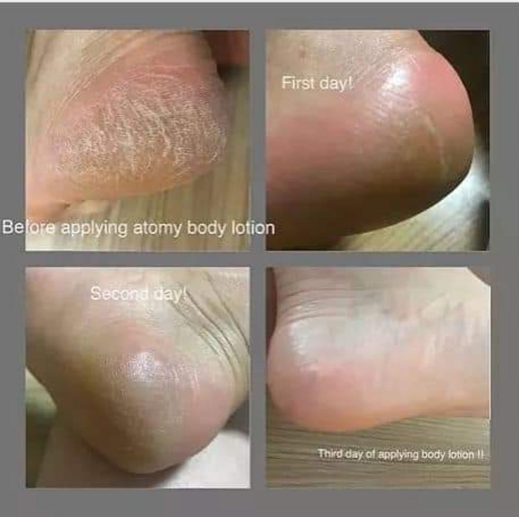 atomy eczema