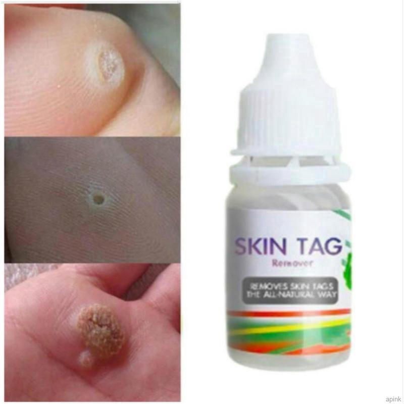 Body Warts Cream Skin Tag Remover Foot Corn Removal