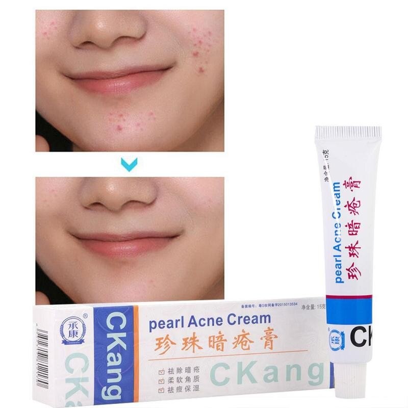 pearl acne cream