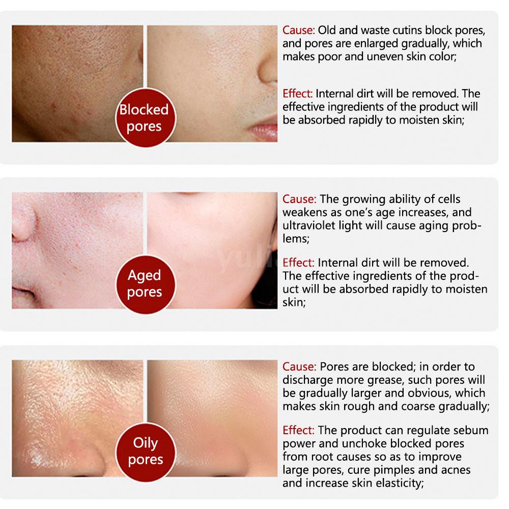 pores treatment