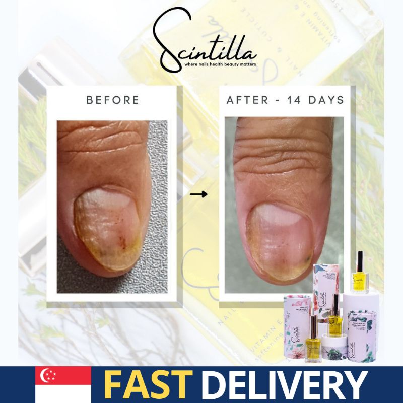 🇸🇬Nail Cuticle Oil Treatment (SG Seller/brittle nails/crack nail/Nail  Fungus/Halal/Nail Treatment/Hari Raya | Shopee Singapore
