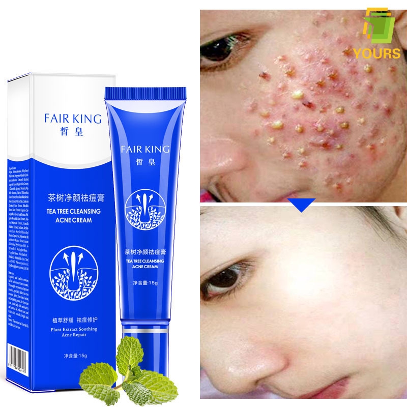 cystic pimple cream