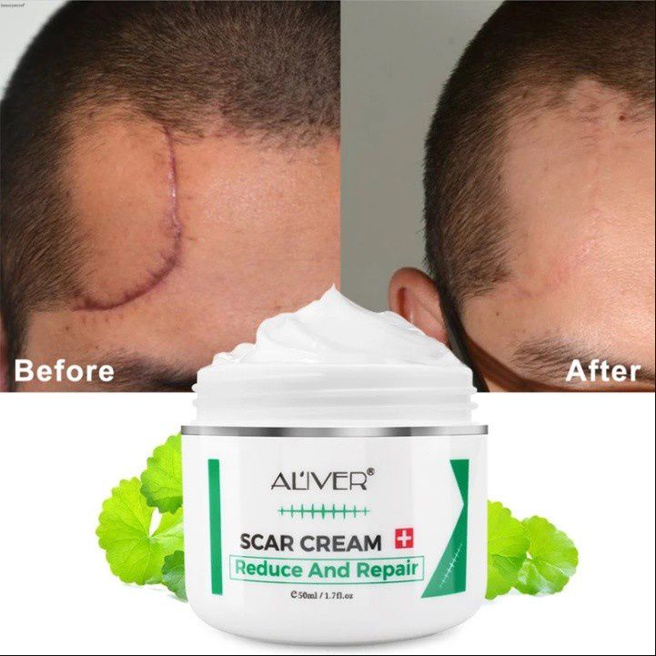 Aliver Scar Repair Cream Remove Acne Scar Remover Stretch Mark Scald