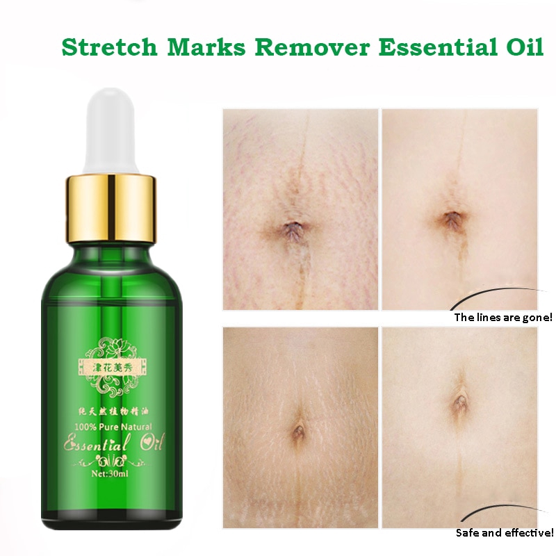 stretch mark healing cream