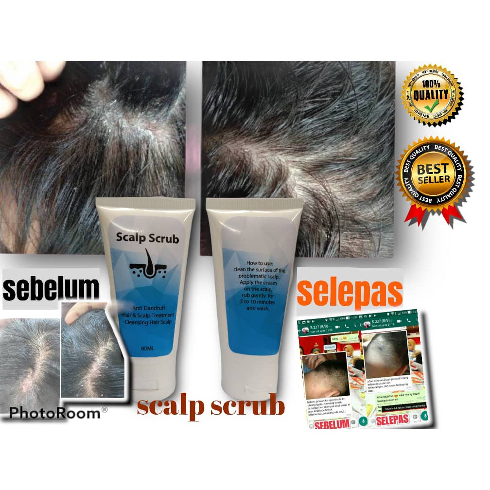 Head Scalp Everyday Soft Eczema Anti Dandruff Dandruff Fade Medicine Shopee Singapore