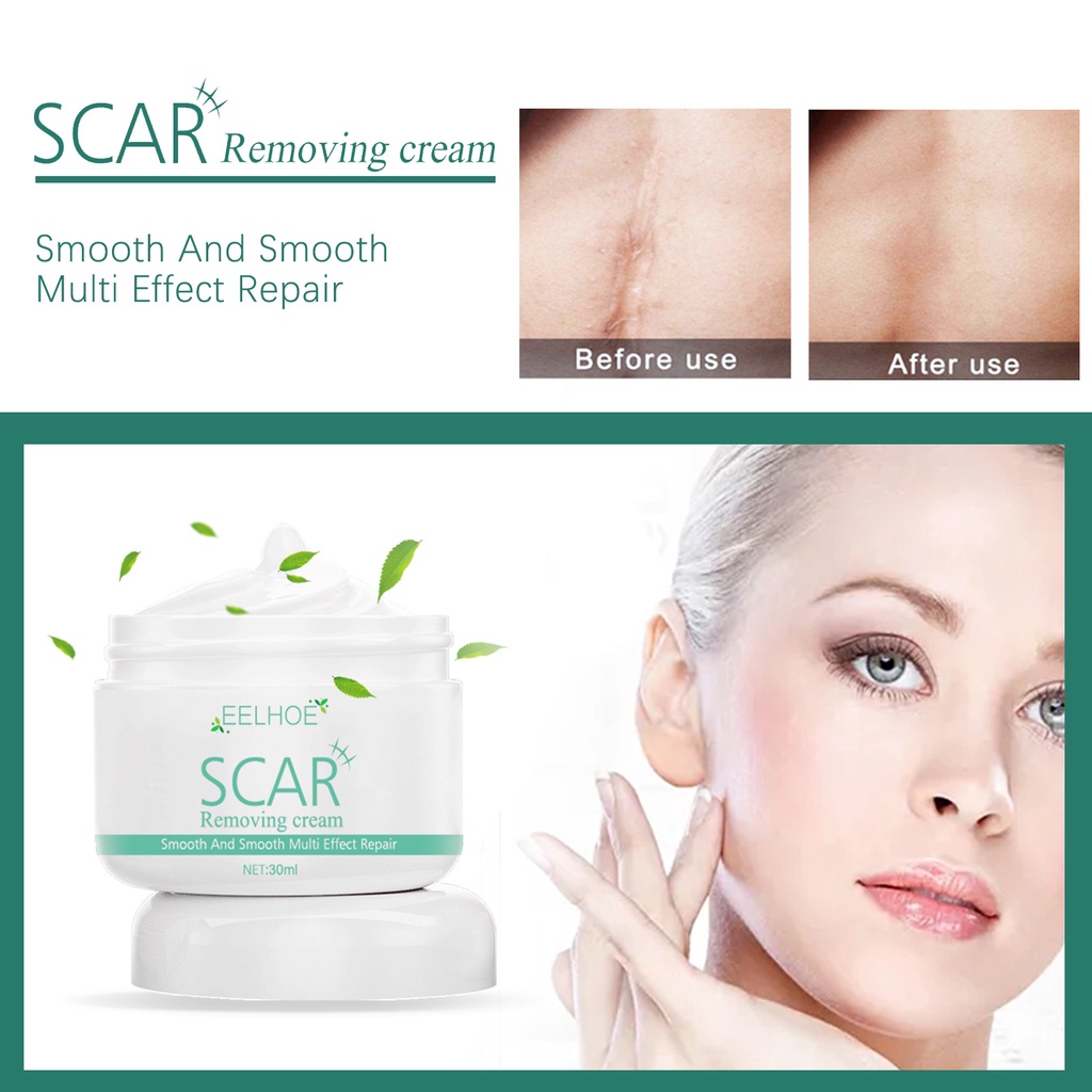 Eelhoe Scar Removing Cream 30ml Scar Repair Cream Desalt Burn Marks Old Scars Post Operative 6573