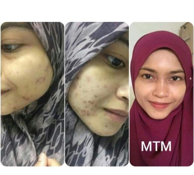 Magic Tamarind Mask Masker Pudar Parut Jerawat Jeragat Berkesan Shopee Singapore