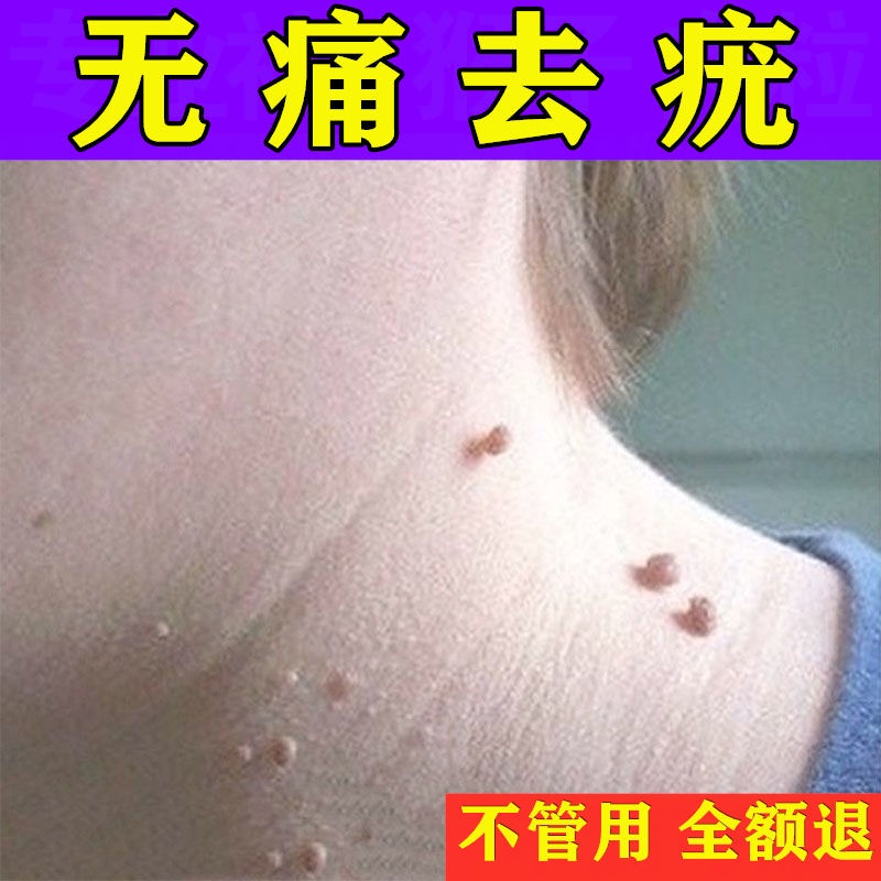 To Remove Filiform Warts Neck And Flat Warts Shopee Singapore