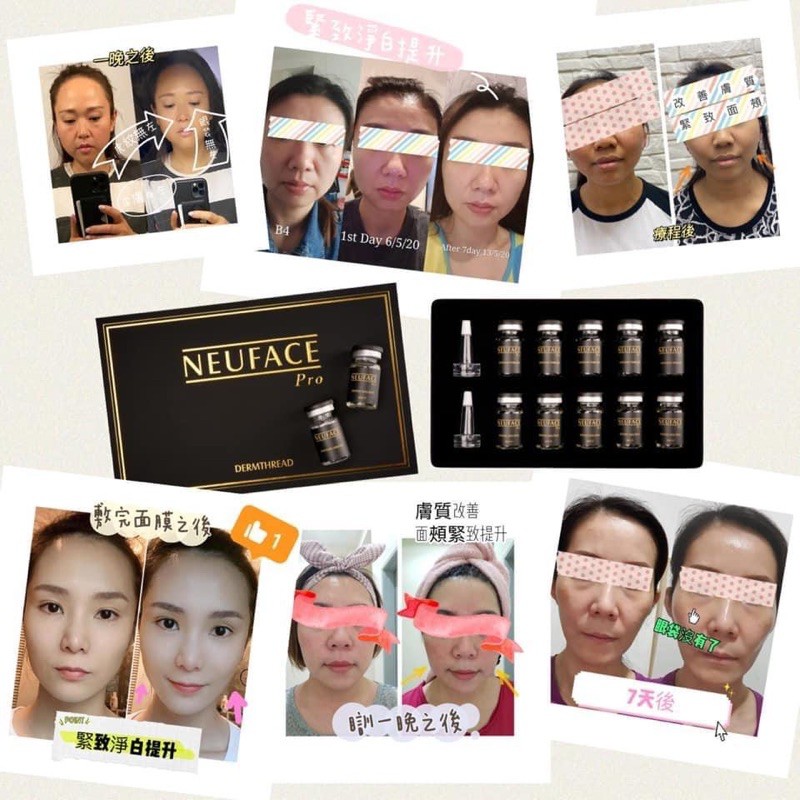 11 11 Authentic Neuface Pro Dermthread Non Surgical Thread Lifting Firming Tightening Improve Complexion Shopee Singapore