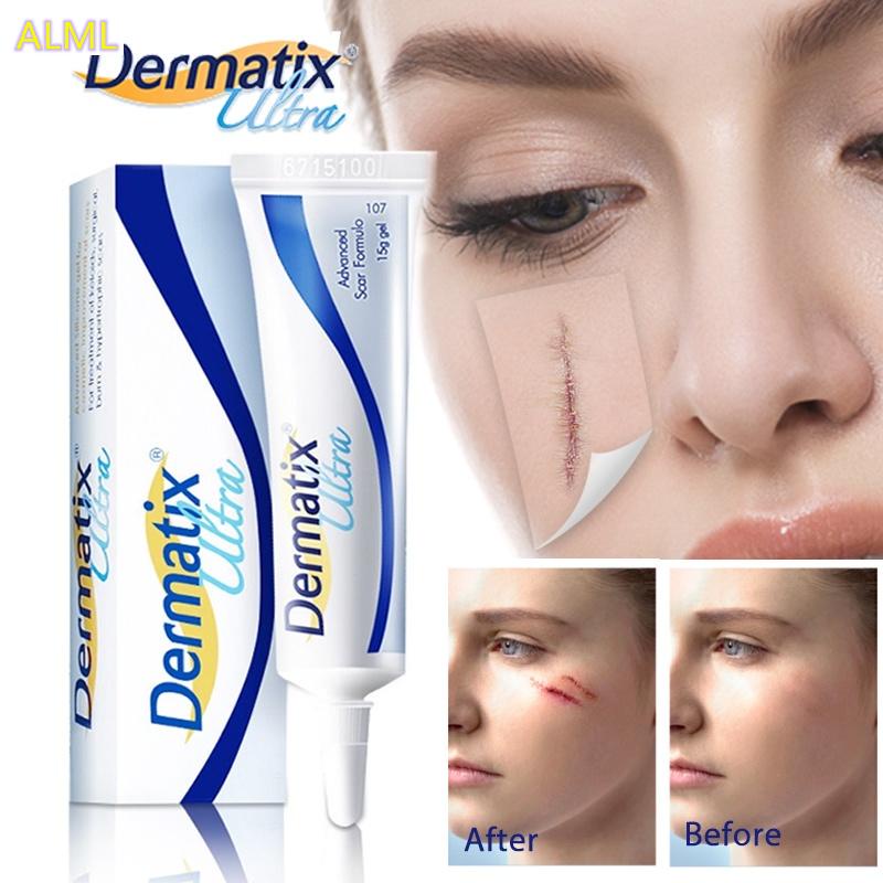 Australia dermatix scar silicone gel ointment double eyelid children