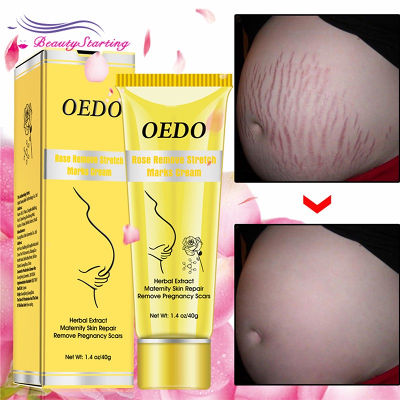 cream to reduce stretch marks