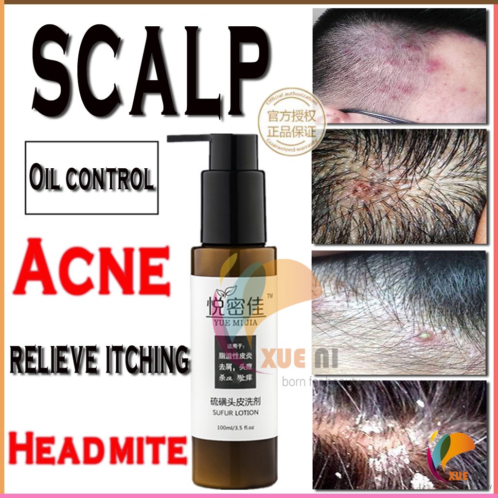 Scalp Folliculitis Treatment Using Organic Coconut Oi - Vrogue.co