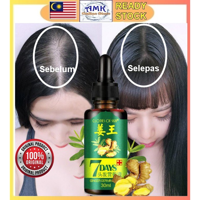 Shop Malaysia Ginger Hair Grow Germinal Oil Growth Essential Tonic Hair Loss Treatment 7 Days Tumbuh Rambut Gugur 姜王头发生长液 Shopee Singapore