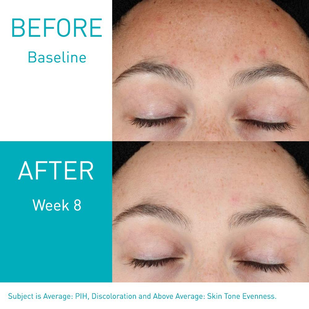 retinol for post acne marks