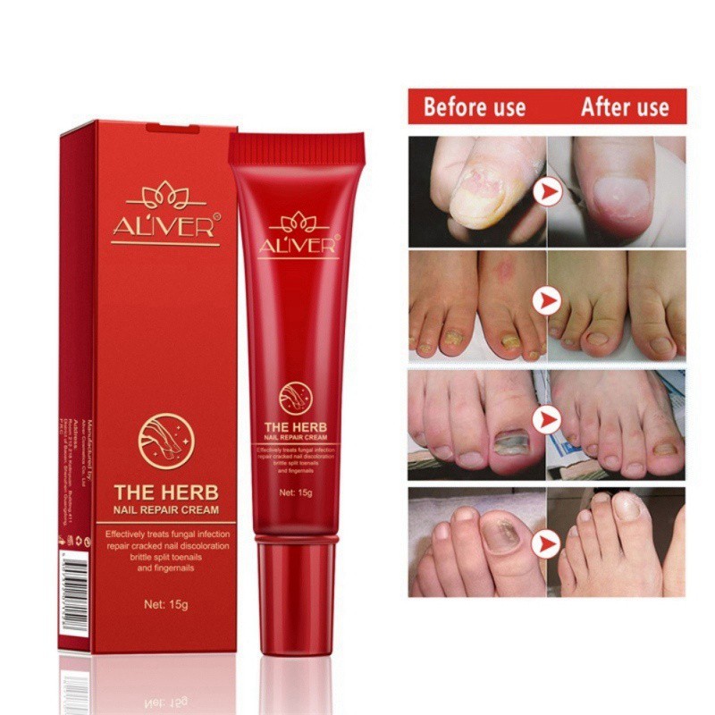 Toe Nail Fungus Treatment Cream Onychomycosis Paronychia Anti Fungal Shopee Singapore