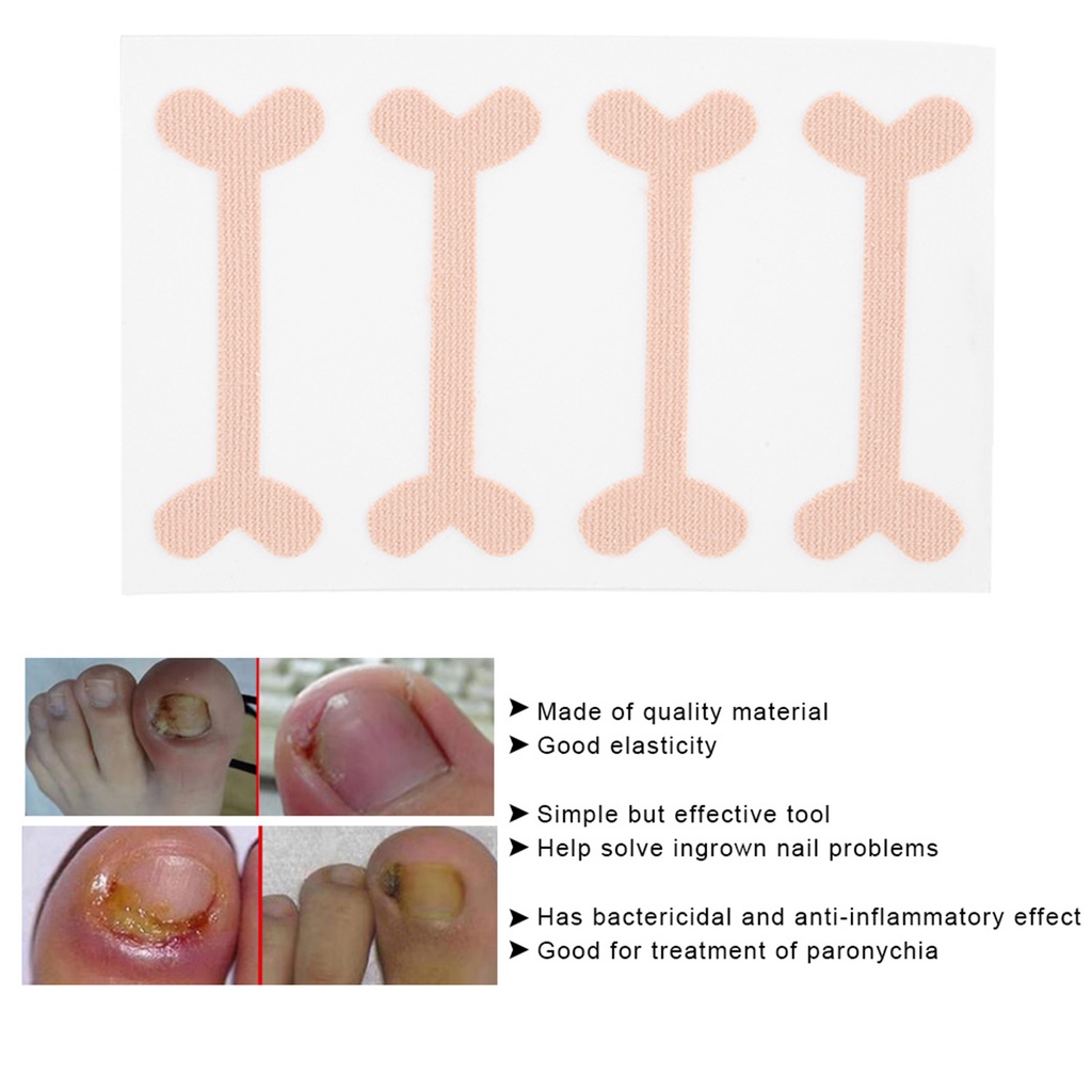 Keaostore 24pcs Ingrown Toenail Correction Bandage Pain Relief