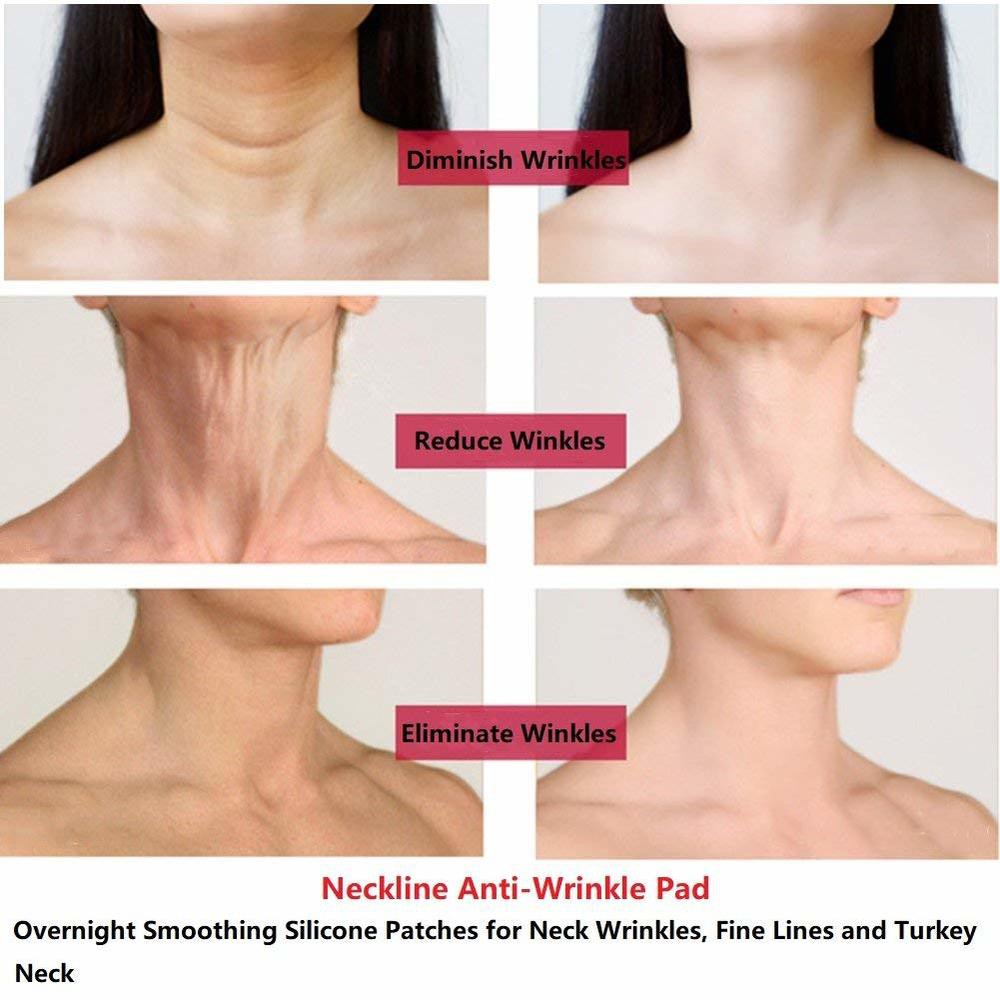 neck wrinkle treatment