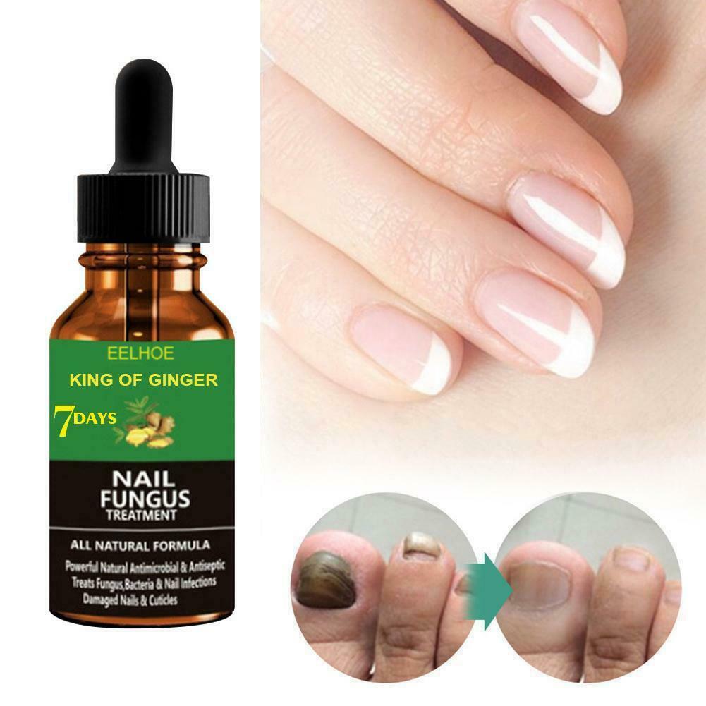 Treatment Fungal Nail Repair Serum Onychomycosis Paronychia Care Nail
