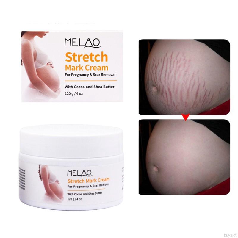 stretch mark cream