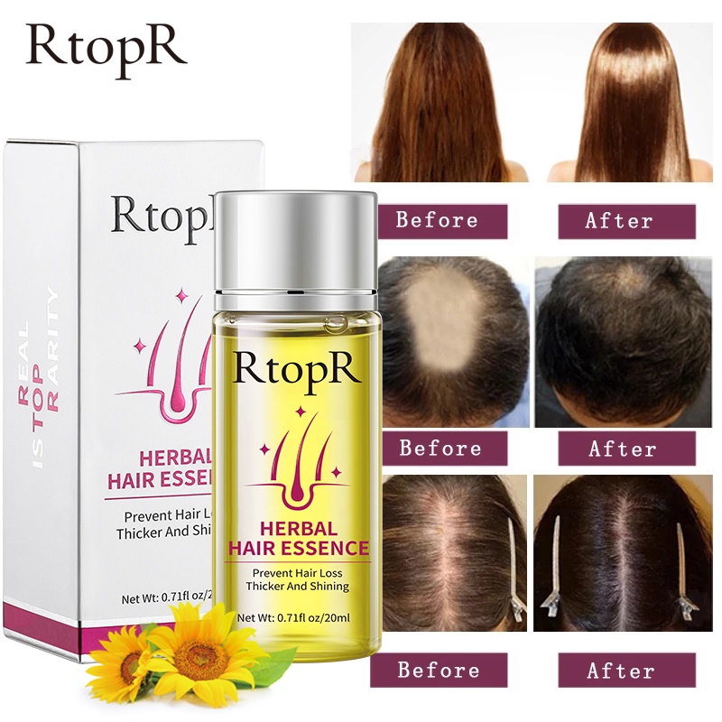 RtopR Herbal Hair Growth Anti Hair Loss Liquid Promote Thick Fast Hair  Growth Treatment 20ml Essential Oil Health Care Beauty Essence | Shopee  Singapore